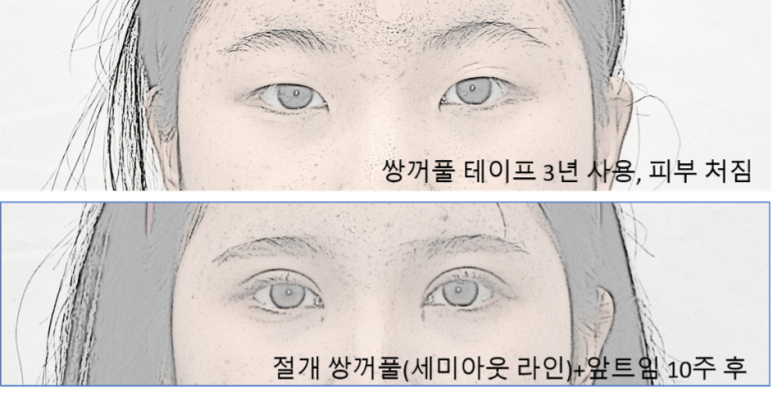 Creating Double Eyelids: What to Know If You’ve Been Using Tape and Eventually Decide on Surgery image 2