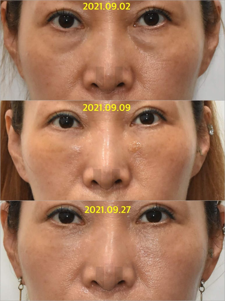 Lower Blepharoplasty vs. Fat Repositioning for Under-Eye Bags - Which Under-Eye Surgery Is Right for Me? image 6