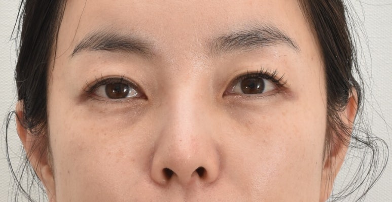 Were you curious about swelling and recovery after lower blepharoplasty? image 3