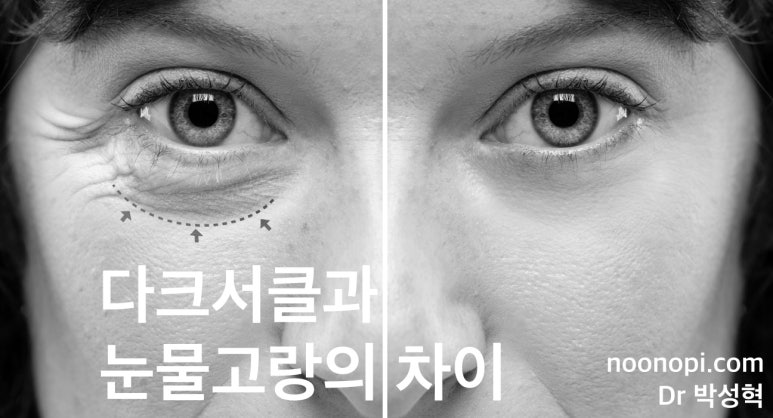 다크서클과 눈물고랑의 차이 관련 이미지 1