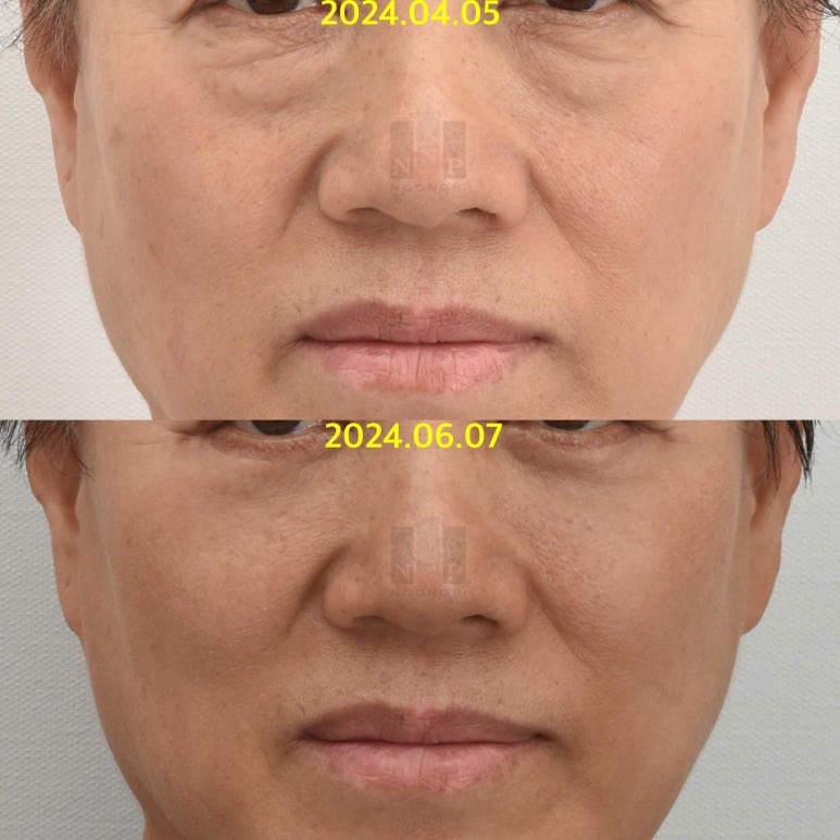 Lower Blepharoplasty vs. Fat Repositioning for Under-Eye Bags - Which Under-Eye Surgery Is Right for Me? image 14