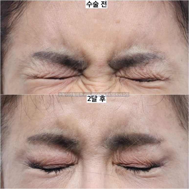 이마거상 비용과 부작용, 회복 과정에 대하여 관련 이미지 15