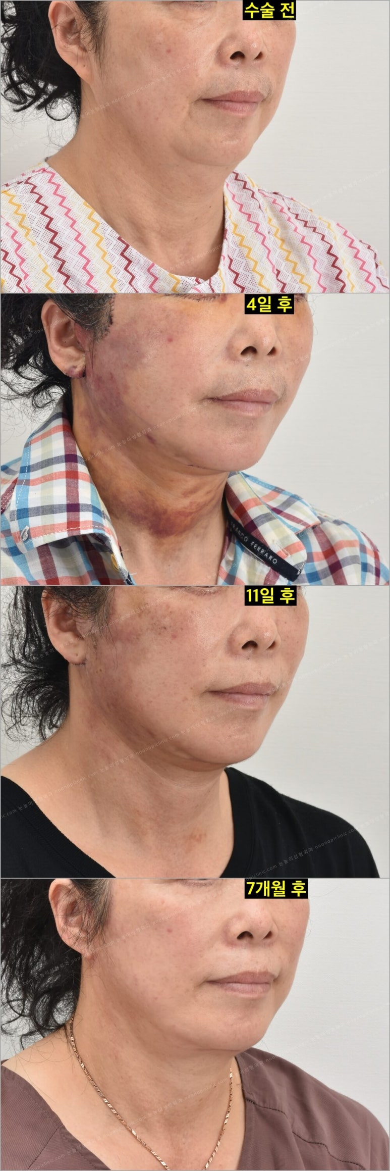 Facelift Scars and Recovery Time image 6