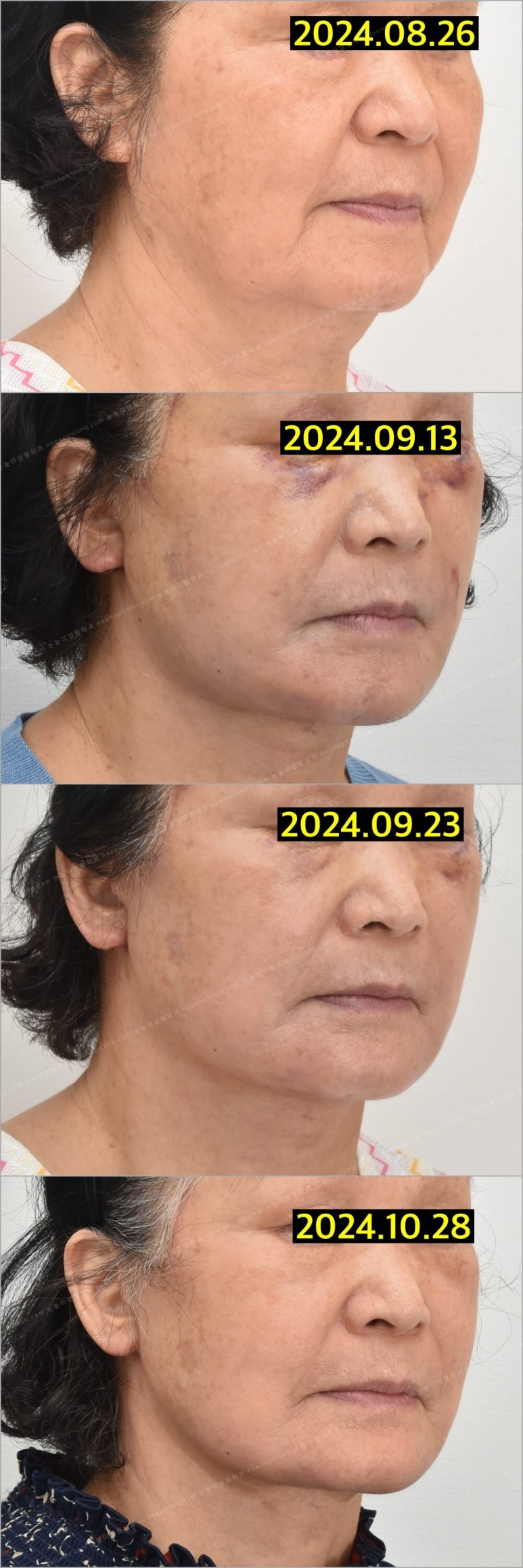 Facelift Scars and Recovery Time image 21