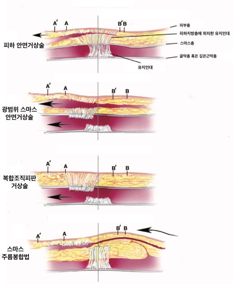 내가 받게 될 안면거상술은 어떤 방법일까? 관련 이미지 2