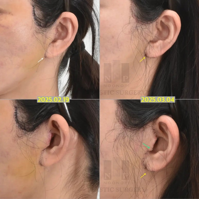 안면거상술, 흉터까지 고려하고 계신가요? 관련 이미지 10