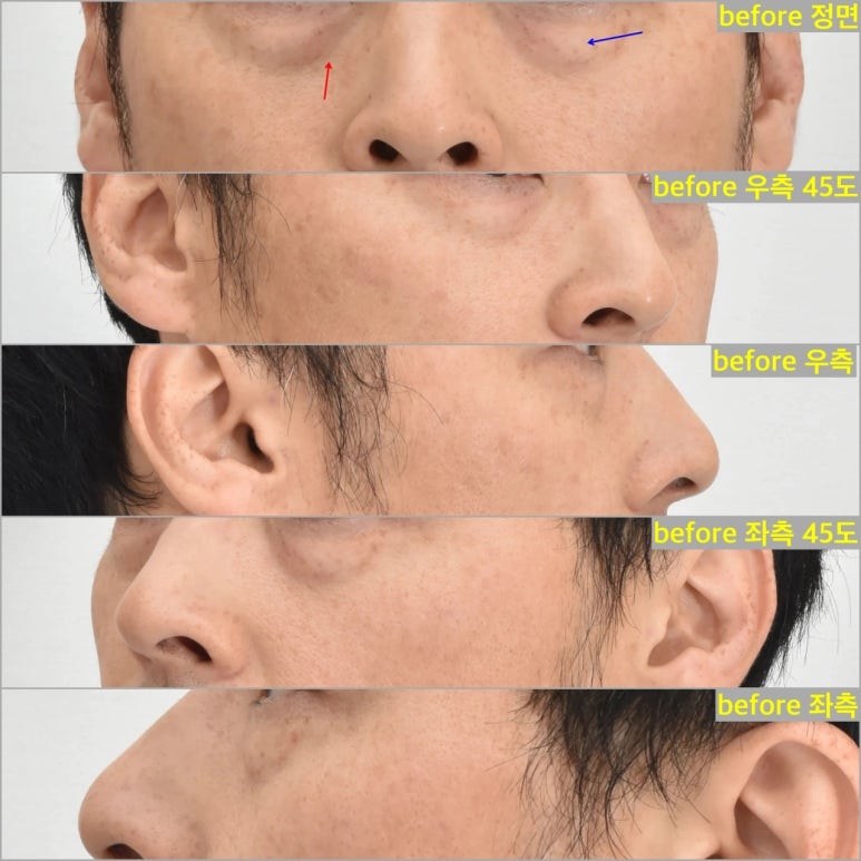 절개없이 눈밑처짐 해결하는법 관련 이미지 1
