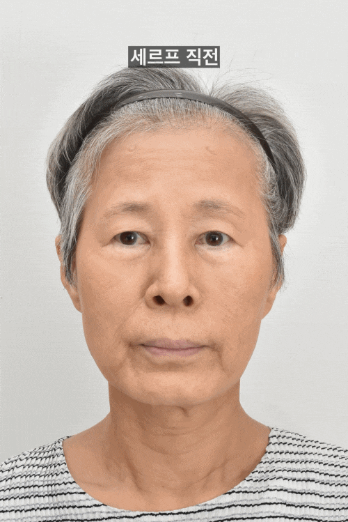 안면거상 후 세르프 리프팅은 언제부터 가능할까 관련 이미지 2