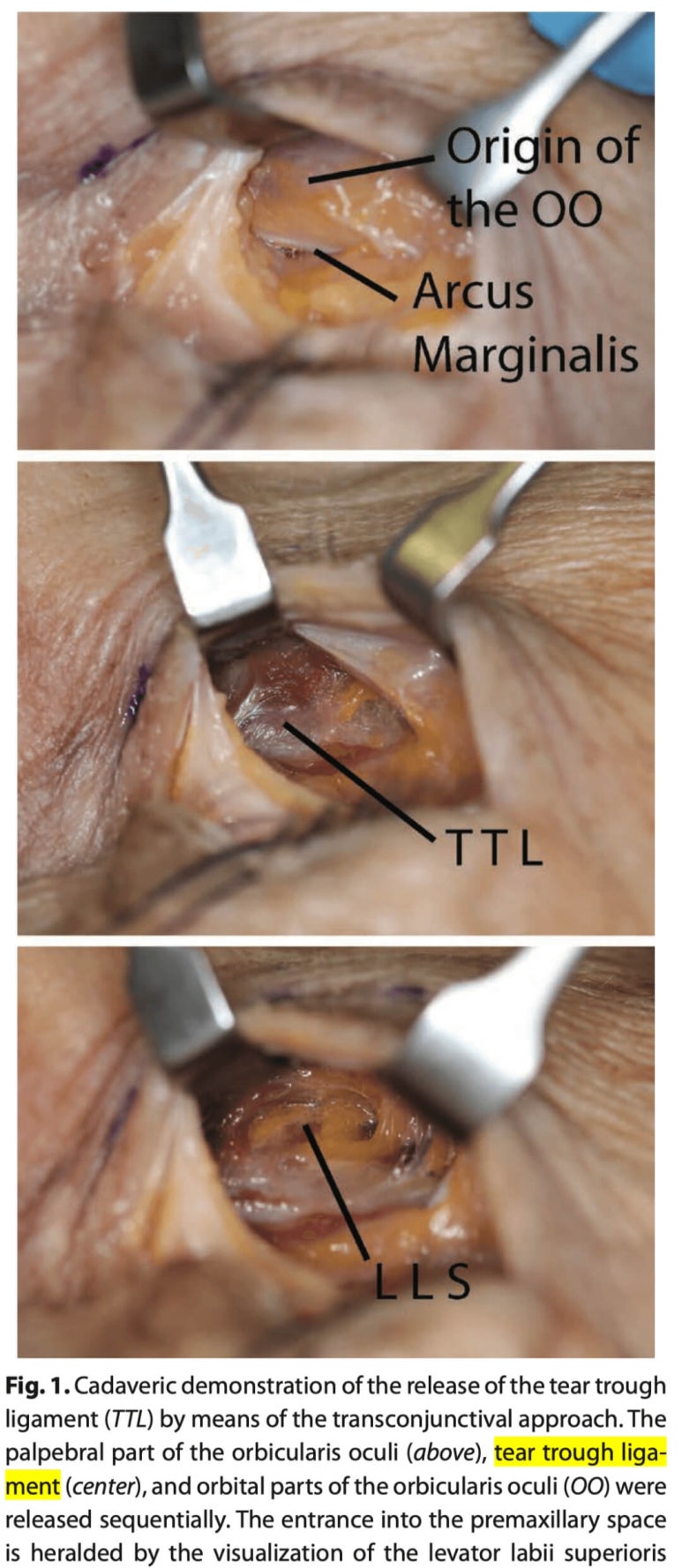 Lower Blepharoplasty vs. Fat Repositioning for Under-Eye Bags - Which Under-Eye Surgery Is Right for Me? image 18