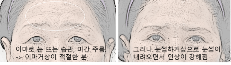 눈썹하거상술 절개 흉터가 신경 쓰이세요? 관련 이미지 3