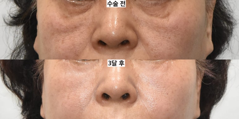 눈밑지방이식은 어떤 경우 하는 게 좋을까 관련 이미지 7