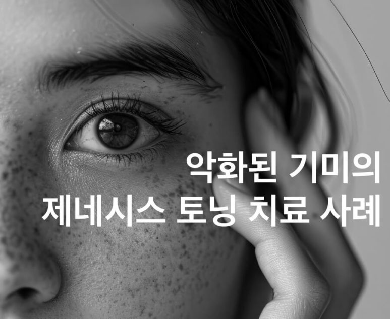 토닝 레이저 한 번으로 기미가 얼마나 좋아질까? 관련 이미지 1