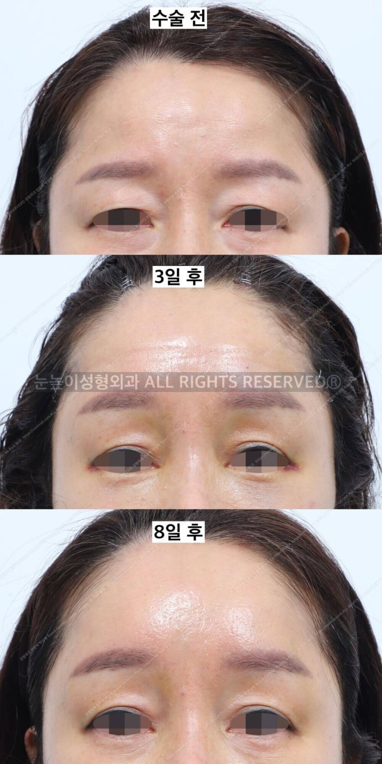이마거상 비용과 부작용, 회복 과정에 대하여 관련 이미지 17