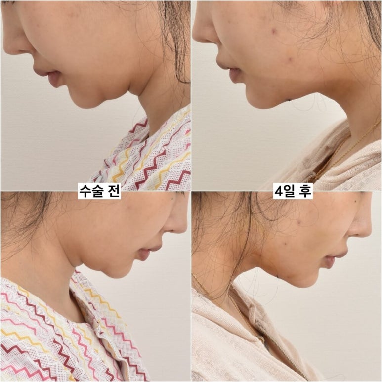 세상에서 가장 안면거상 수술을 잘하는 닥터 관련 이미지 20
