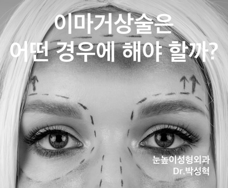 [Case Report] In What Cases Is Endoscopic Forehead Lift Performed? How Does It Change? (feat. High-Level Aftercare) image 1