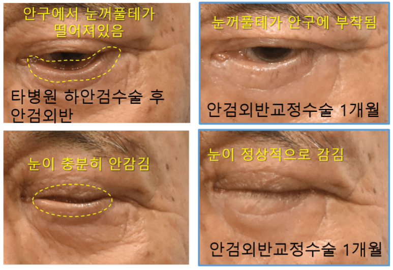 하안검수술 부작용 예방과 대처 방법 관련 이미지 3