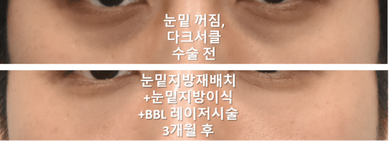 눈밑지방이식 어떤 경우에 효과적일까? 과도함, 부작용 방지 위해 관련 이미지 5