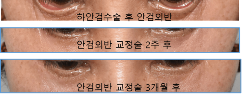 하안검수술 부작용 예방과 대처 방법 관련 이미지 2
