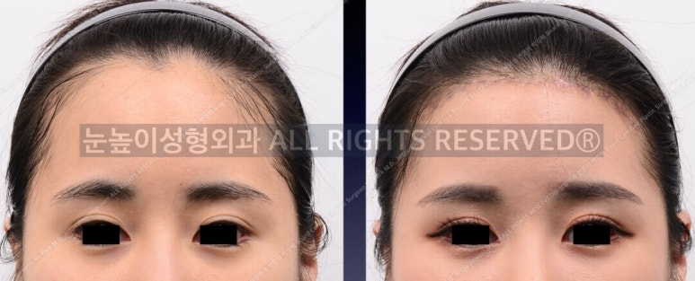 Forehead Reduction Surgery vs Hair Transplant image 16