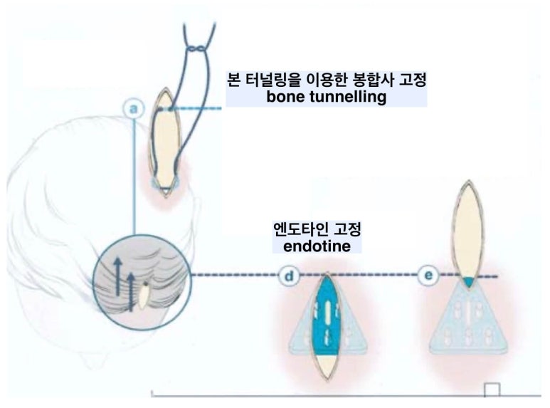 이마거상 비용과 부작용, 회복 과정에 대하여 관련 이미지 5