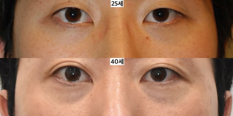 눈밑지방이식은 어떤 경우 하는 게 좋을까 관련 이미지 9