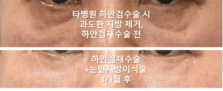 눈밑지방이식 어떤 경우에 효과적일까? 과도함, 부작용 방지 위해 관련 이미지 6