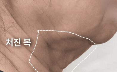 성형외과에서는 이중턱 리프팅을 이렇게 권한다(목거상수술) 관련 이미지 9