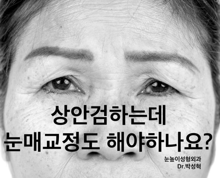 Do I Need Ptosis Correction When Getting Upper Blepharoplasty? image 1