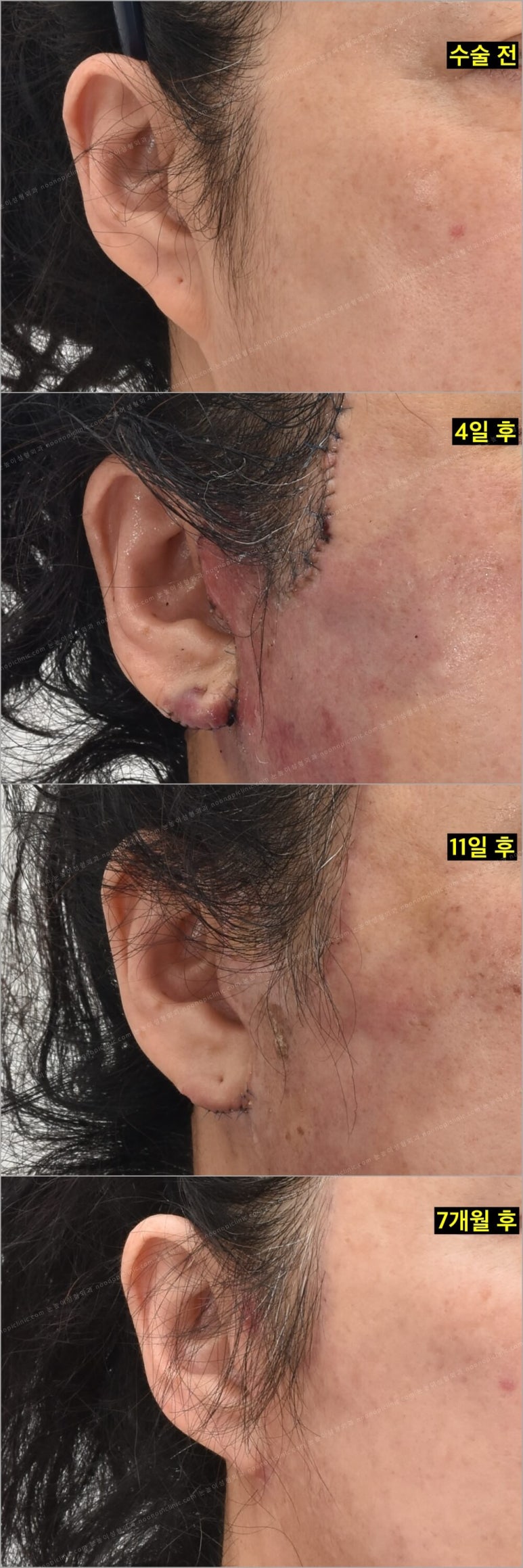 Facelift Scars and Recovery Time image 8