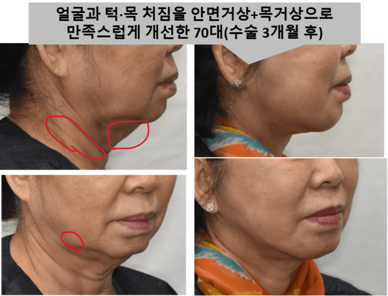 이중턱 치료 : 목거상술의 실제 효과는? 관련 이미지 3
