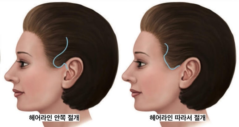 안면거상에서 시행하는 절개 위치는? 관련 이미지 2