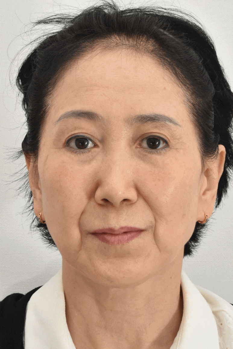 Brow Lift Scars and Hair Loss image 1