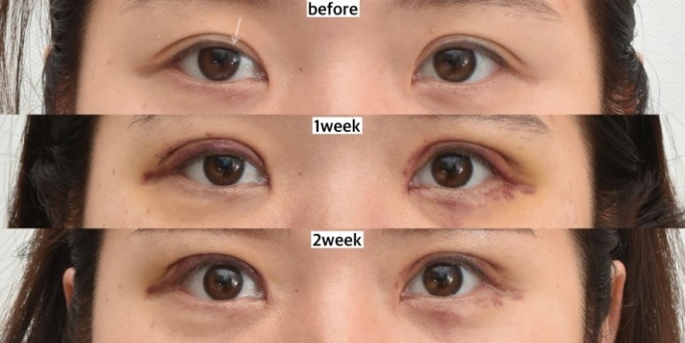 What Is Ptosis Correction? (Graphic Images Warning ⚠️) image 10