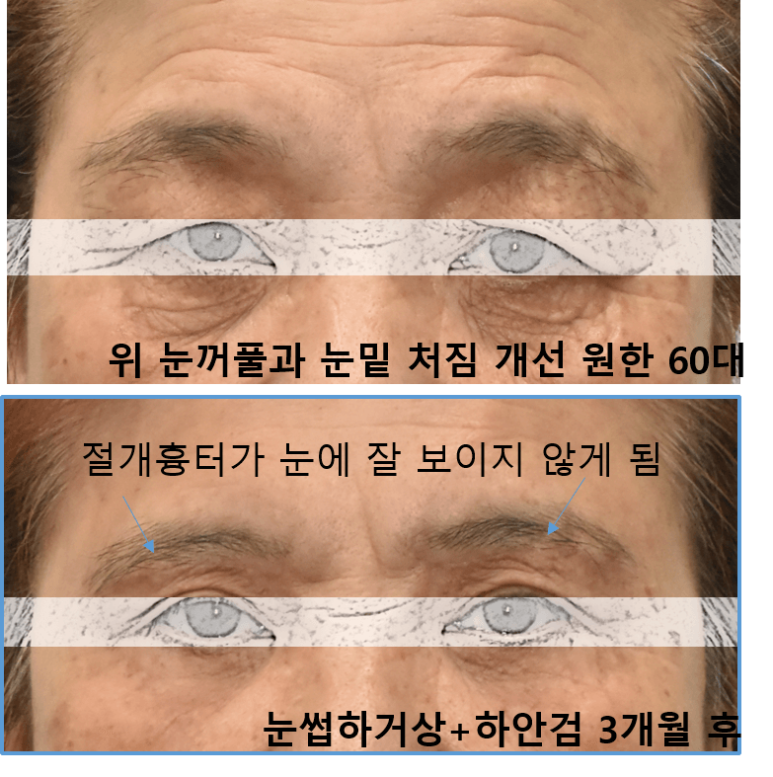 눈썹하거상술 절개 흉터가 신경 쓰이세요? 관련 이미지 1