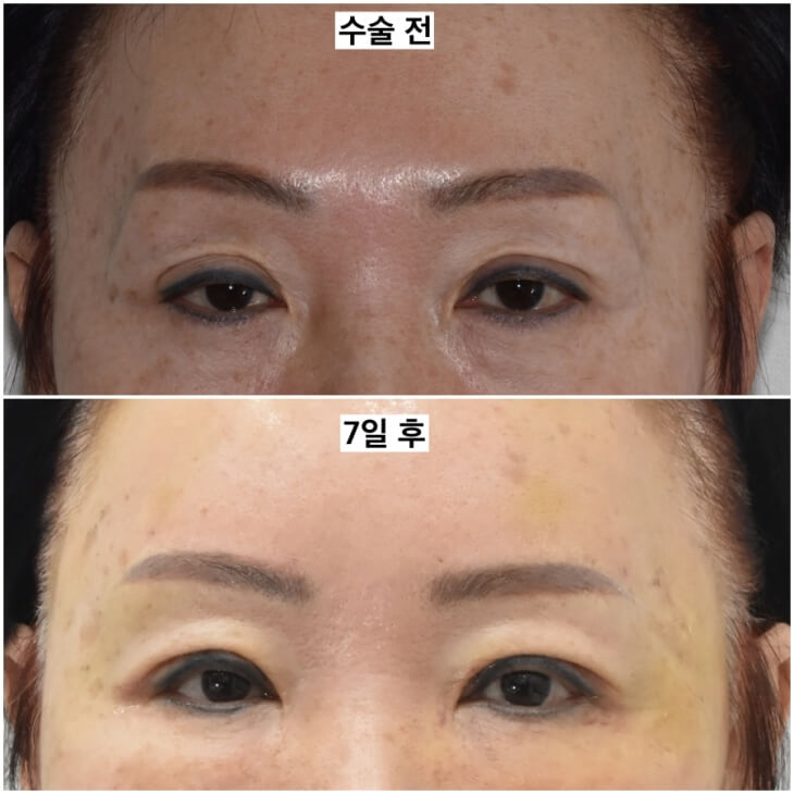 If You’re Looking Into Cosmetic Surgery as a Mother’s Day Gift for Your Parents image 3