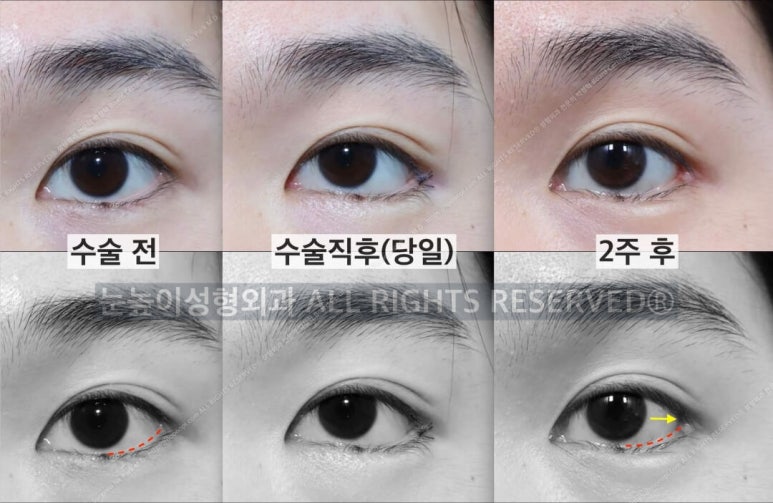 성형외과 전문의가 말하는 아름다운 눈이란 관련 이미지 12