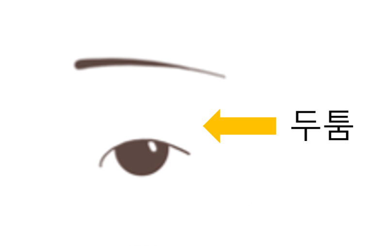 It’s Not the Burial Method That Caused the Droopy Sausage Eye After Double Eyelid Surgery image 2