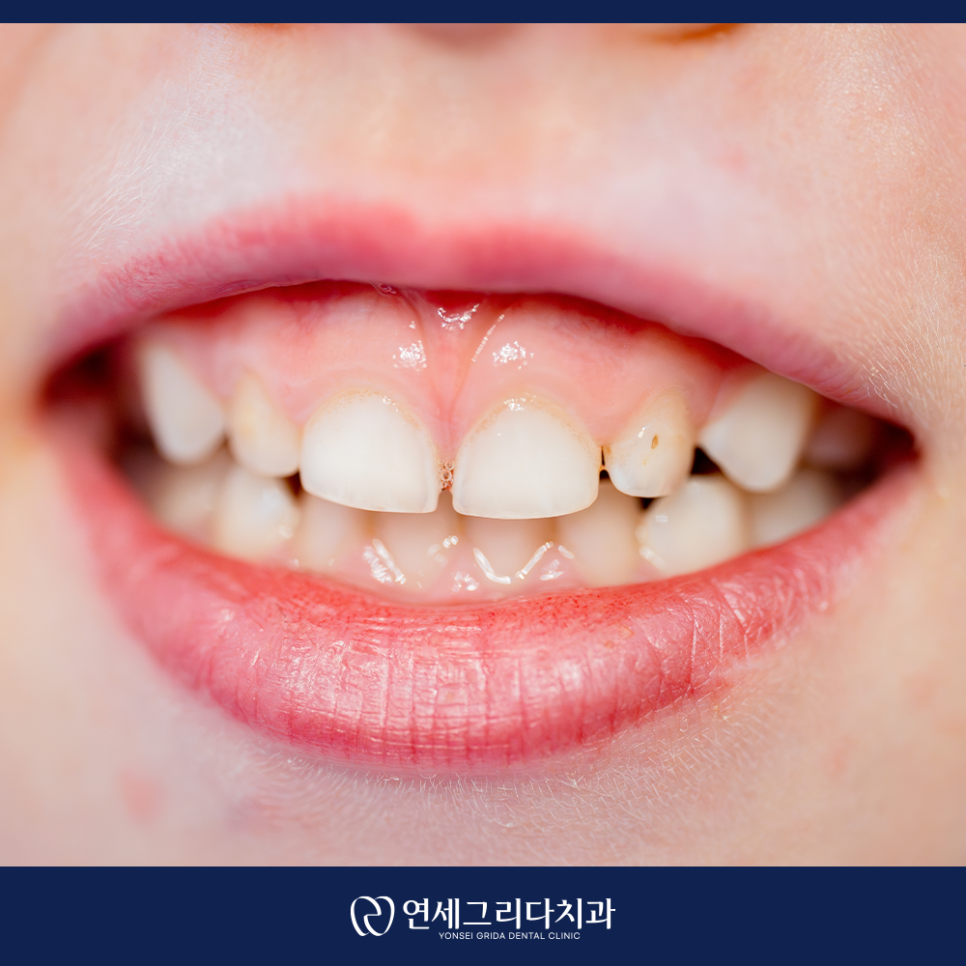 What Is That Black Spot on Your Tooth? Distinguishing Staining from Cavities image 2