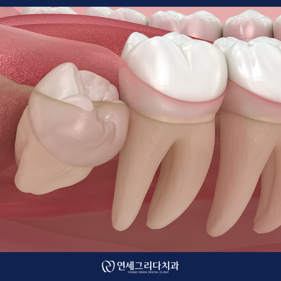 Do You Really Need to Have a Wisdom Tooth Removed at Yeomchang Station? image 6