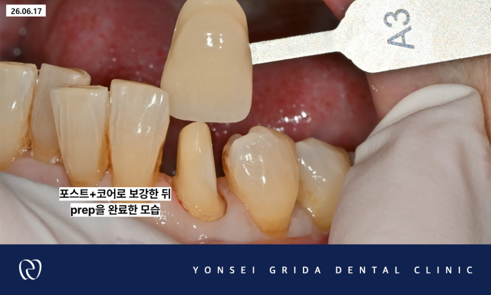 등촌역치과, 신경치료 후 치아가 약해졌다면 관련 이미지 7