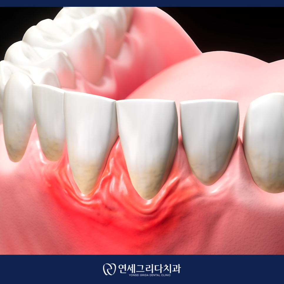 Check If Your Gums Bleed When Brushing: Symptoms of Gingivitis! image 2