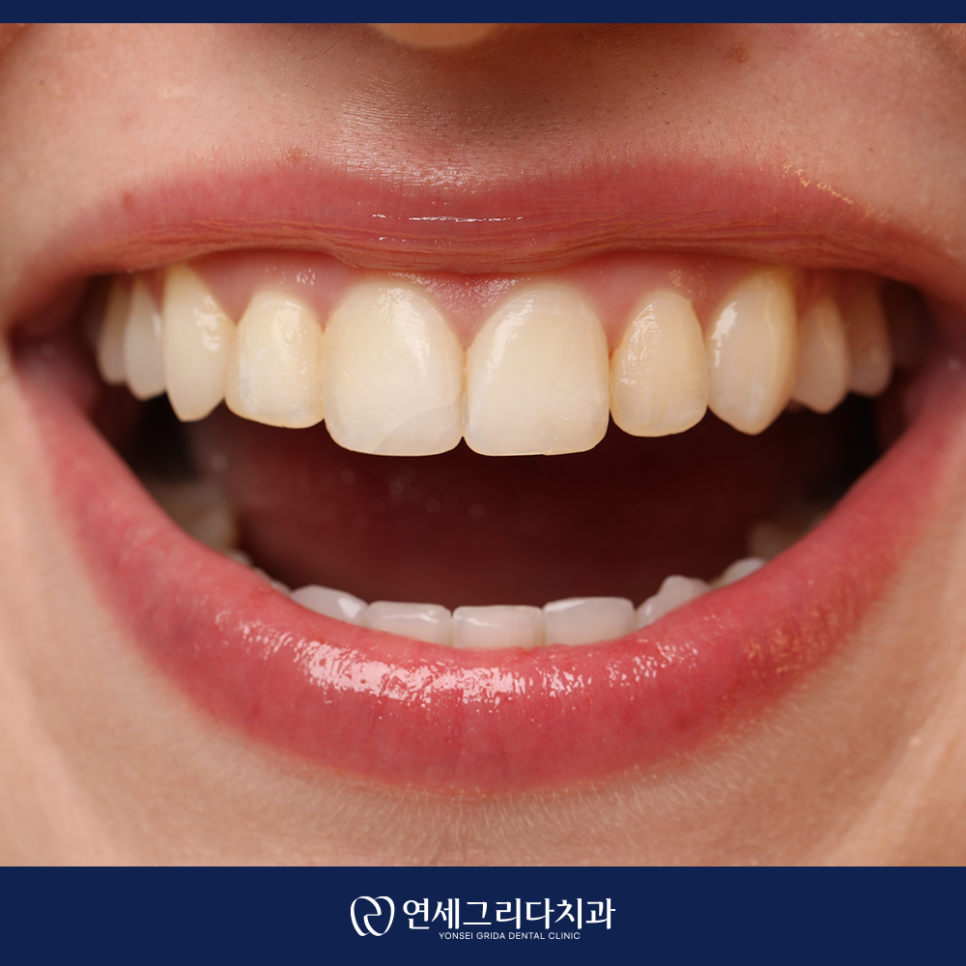 염창동치아미백, 자연스러운 결과를 원한다면 관련 이미지 5