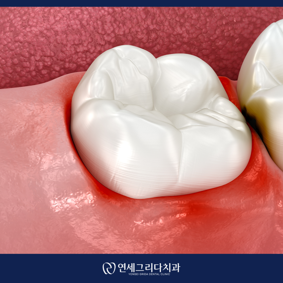 What Causes Blood to Pool in the Gums? image 2