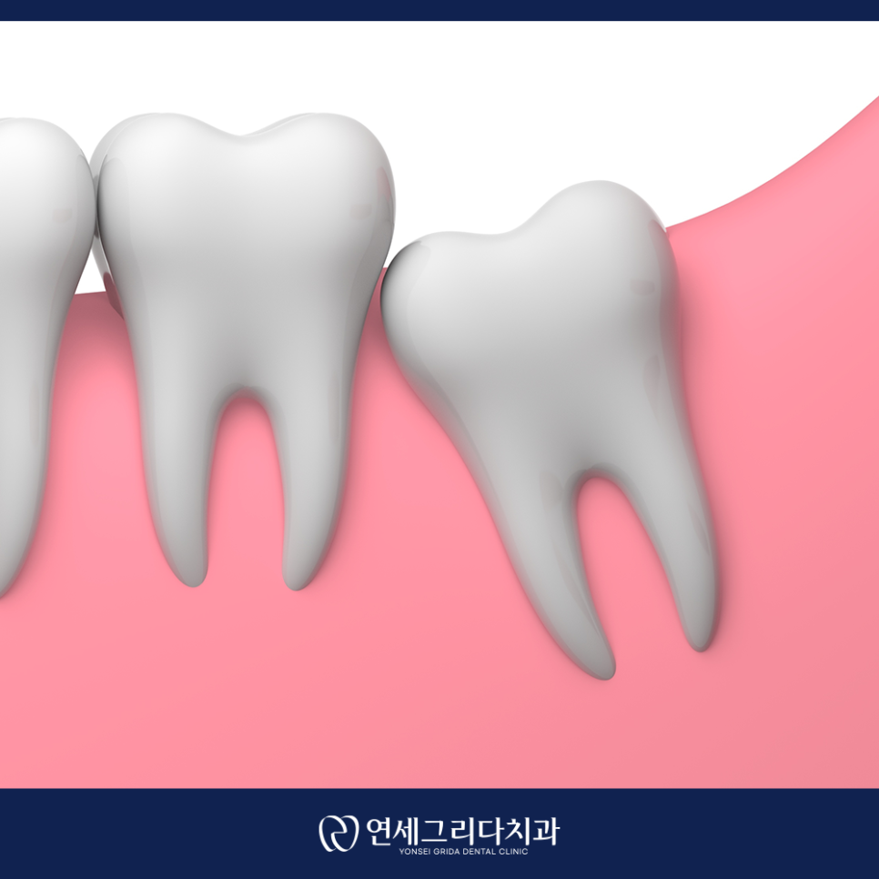 사랑니 발치 후 흡연, 꼭 알아야 할 주의사항 관련 이미지 2