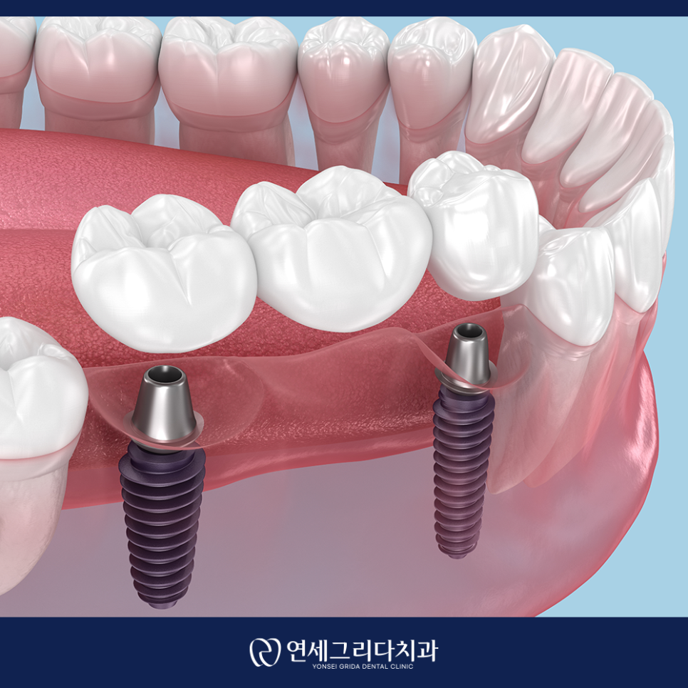 Deungchon Station Dental Implants: How to Use Them for as Long as Natural Teeth image 5