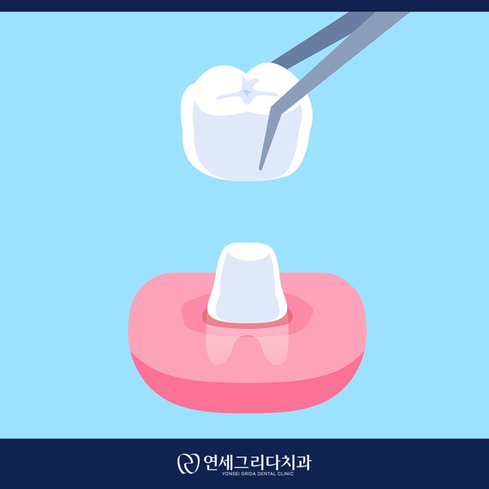 크라운 교체 시기, 이런 증상이 있다면 교체 신호 관련 이미지 3