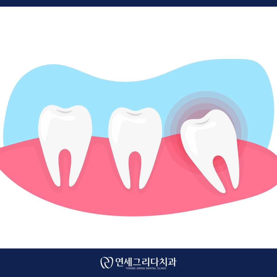 사랑니 발치 후 흡연, 꼭 알아야 할 주의사항 관련 이미지 3