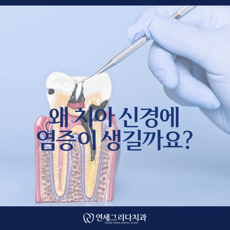 염창역신경치료, 신경치료가 필요한 치아의 신호는? 관련 이미지 3