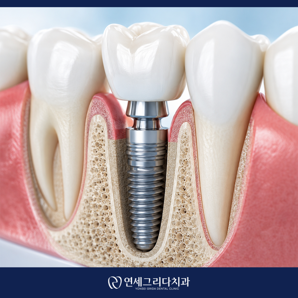 Deungchon Station Dental Implants: How to Use Them for as Long as Natural Teeth image 3