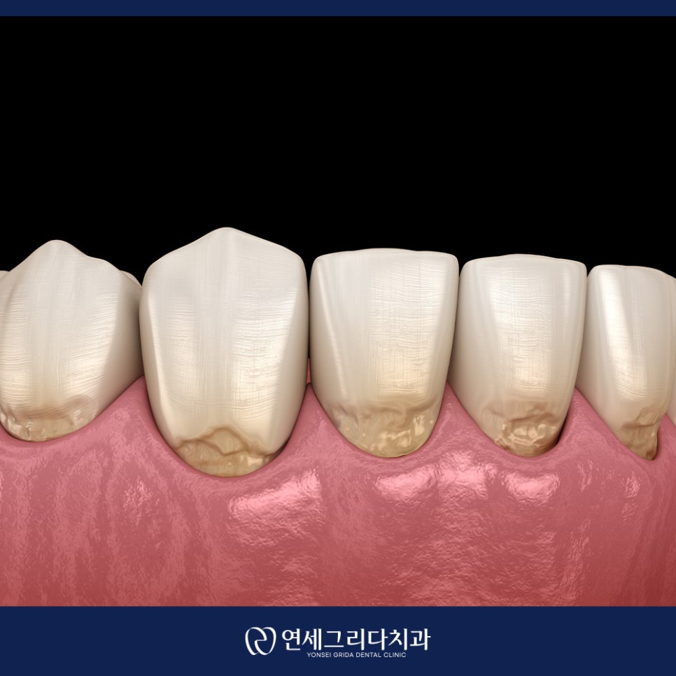 치경부마모증 시린 증상이 생겼다면? 관련 이미지 7